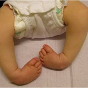 Clubfoot