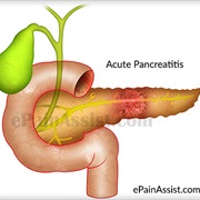 Acute Pancreatitis