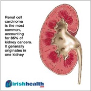 World Kidney Cancer Q&A Day (June 22)