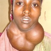 Goiter