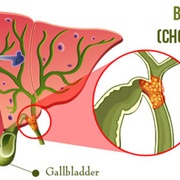 Bile Duct Cancer