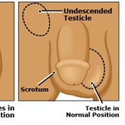 Undescended  Testicle