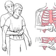Heimlich Maneuver