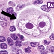 Hodgkin's Lymphoma