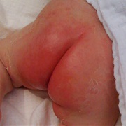 Diaper Rash