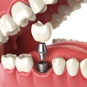 Get a Tooth Implant