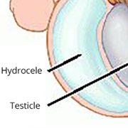 Hydrocele