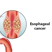 Esophageal Cancer
