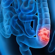 Colorectal Cancer