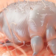Scabies