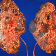 Polycystic Kidney Disease