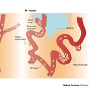 Vascular Cancer