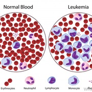 Acute Lymphoblastic Leukaemia