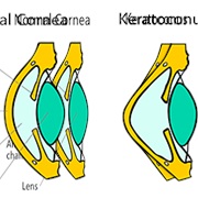 Keratoconus Day (November 10)