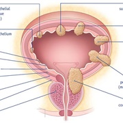 Bladder Cancer