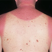 Sunburns