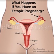 Ectopic Pregnancy
