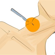 Perform a Tracheotomy