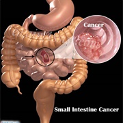 Intestinal Cancer