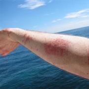 Get Stung by a Jellyfish