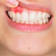 Dental Abscess