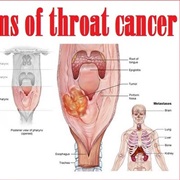 Throat Cancer