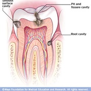 Cavity