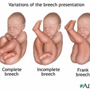 Breech Birth