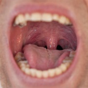 Adenoids