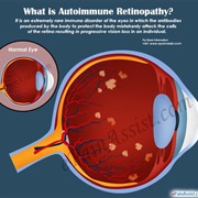 Autoimmune Retinopathy