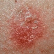 Skin Cancer (Non-Melanoma)