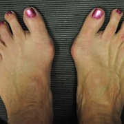 Bunion