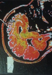 New Frankensteins (Allan Hall)