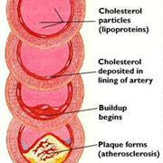 High Cholestrol