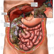 Perforated Bowel