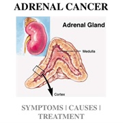 Adrenal Cancer
