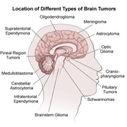 Brain Tumor