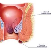 Hemorrhoids