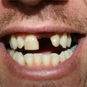 Missing Teeth