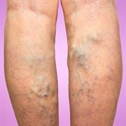 Varicose Veins