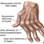 Rheumatoid Arthritis