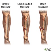 Fractured Bone