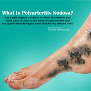 Polyarteritis Nodosa