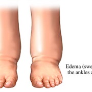 Edema