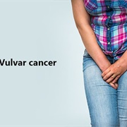 Vulvar Cancer