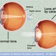 Cataracts