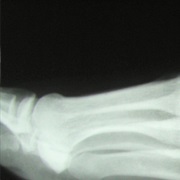 Broke a Bone