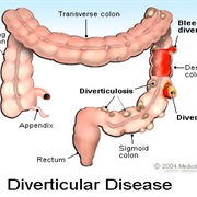 Diverticulosis/Diverticulitis