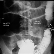 Obstructed Bowel