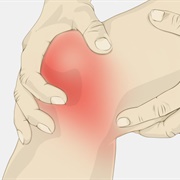 Sprained Knee